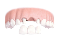 Versorgung mehrerer Zähne